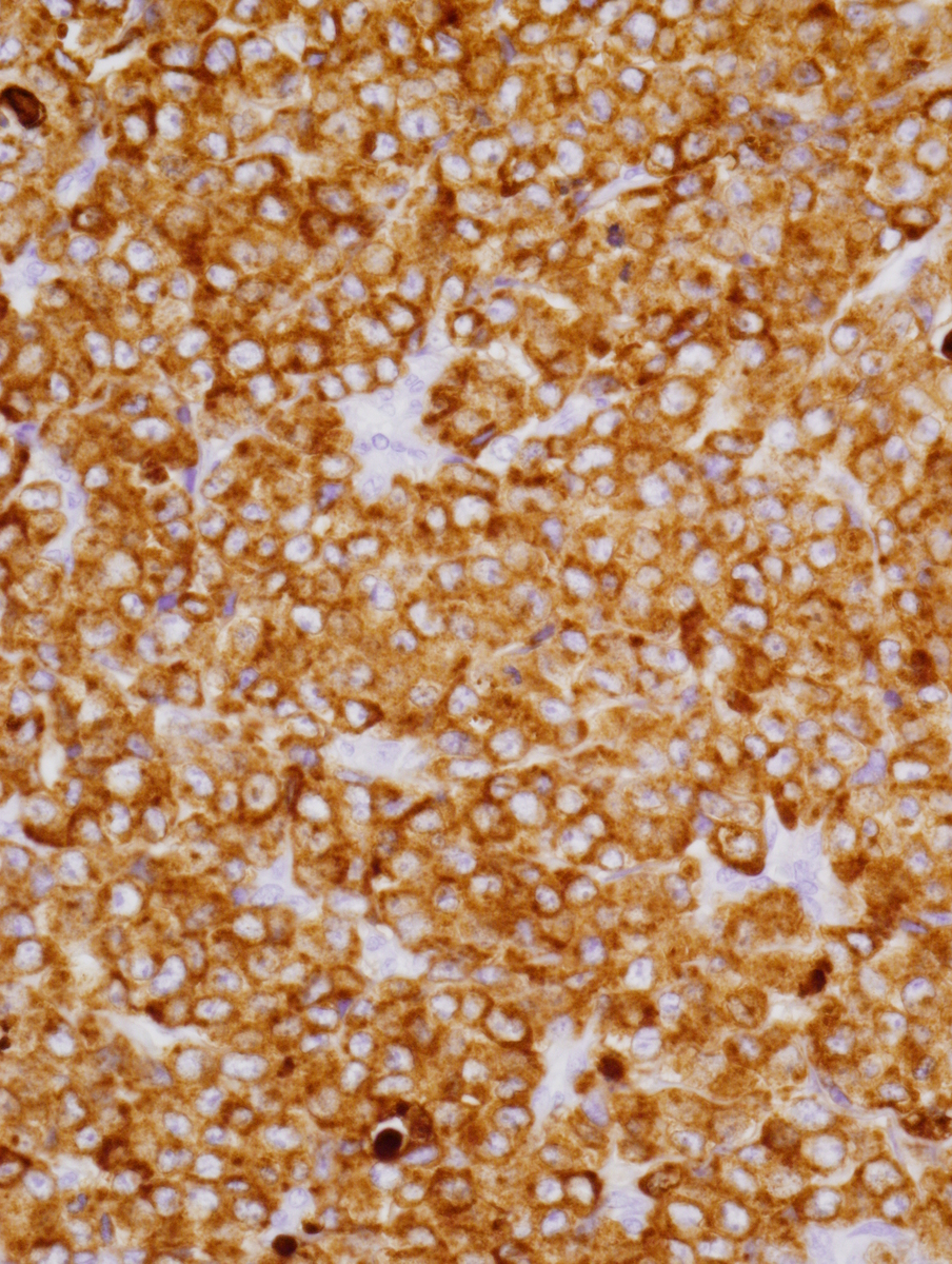 Fig. 3 Left buttock lesion. Immunohistochemistry for CD45, CD33 (Fig. 3a), lysozyme (Fig. 3b), and CD68 (Fig. 3c) were diffusely and strongly positive. CD34 (Fig. 3d), CD117 (Fig. 3e), and myeloperoxidase (Fig. 3f) were not expressed. Additionally, CD56, cytokeratin AE1/AE3, cytokeratin 17, cytokeratin 20, Melan-A, PSA, S-100, CD1a, CD3, CD20, CD21, CD35, CD56, CD123, CD138, CD163, and PAX-5 were negative.
